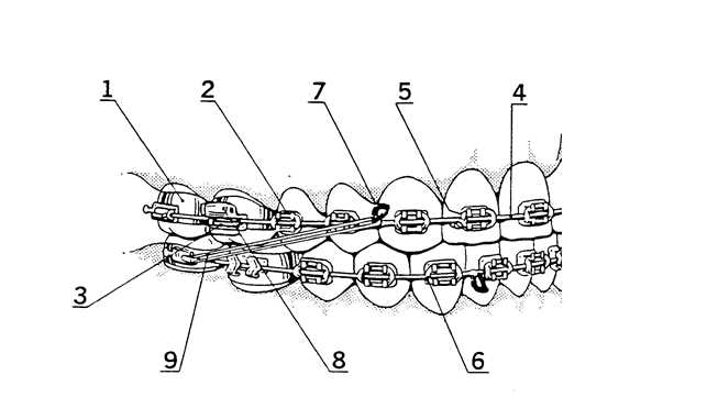 braces parts diagram