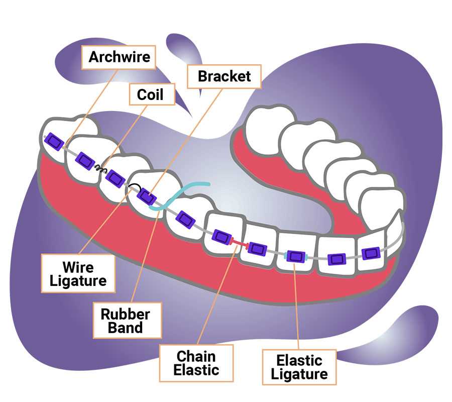 braces parts diagram