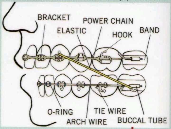 braces parts diagram