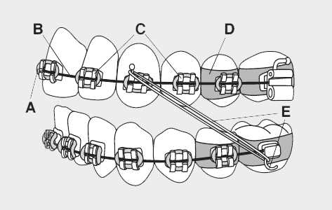 braces parts diagram