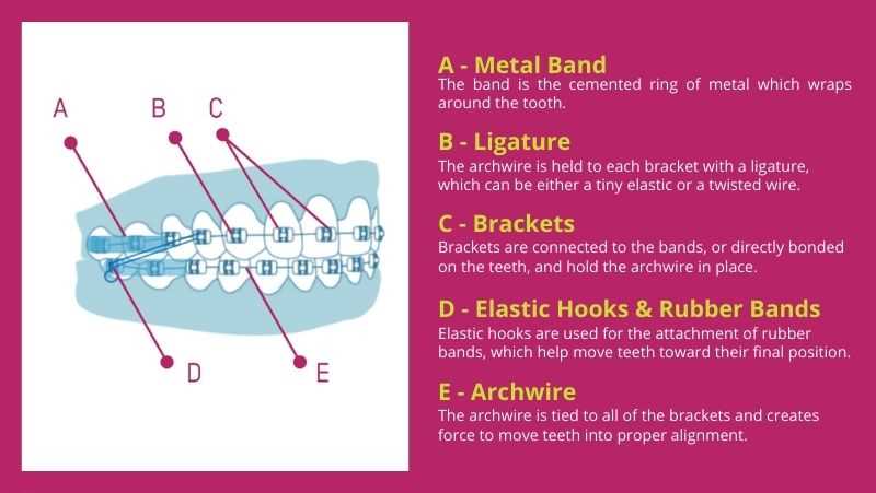 braces parts diagram