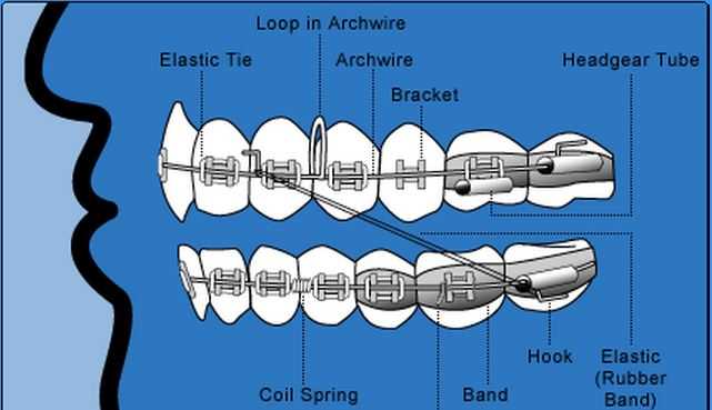 braces parts diagram