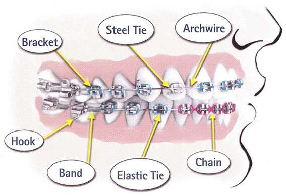 braces parts diagram