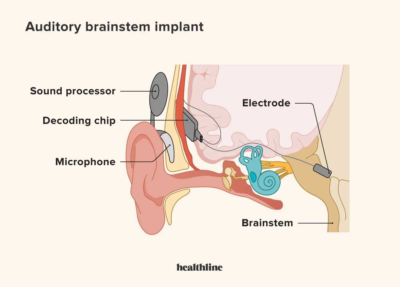 parts of a cochlear implant diagram