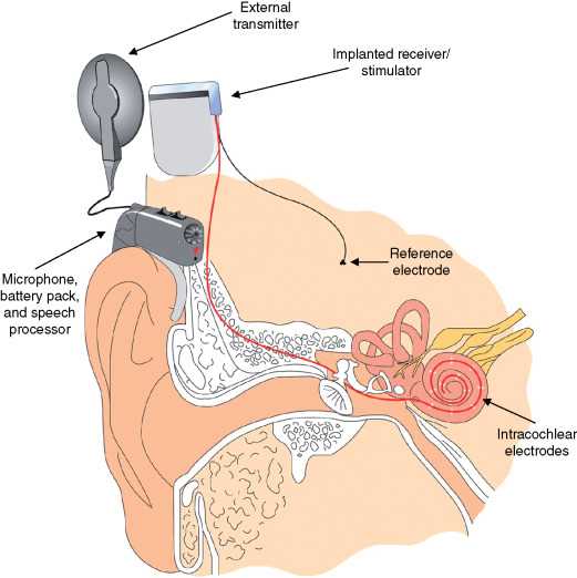 parts of a cochlear implant diagram