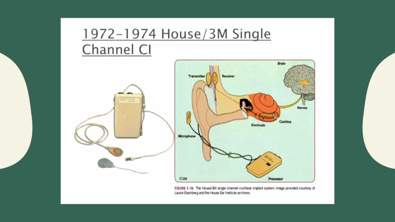 parts of a cochlear implant diagram