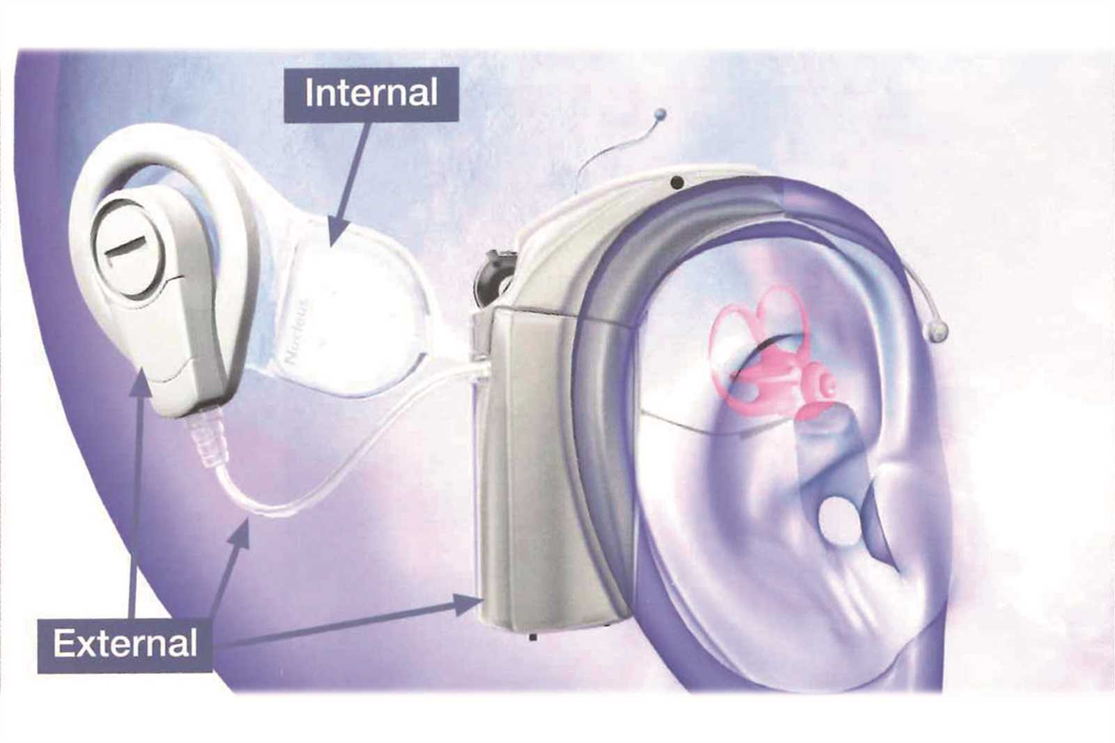 parts of a cochlear implant diagram