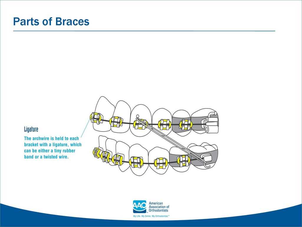 braces parts diagram