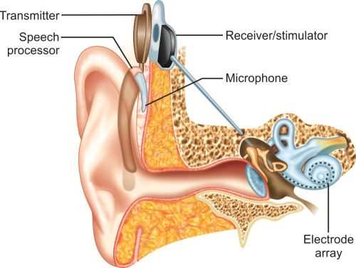 parts of a cochlear implant diagram