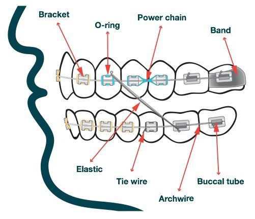 braces parts diagram